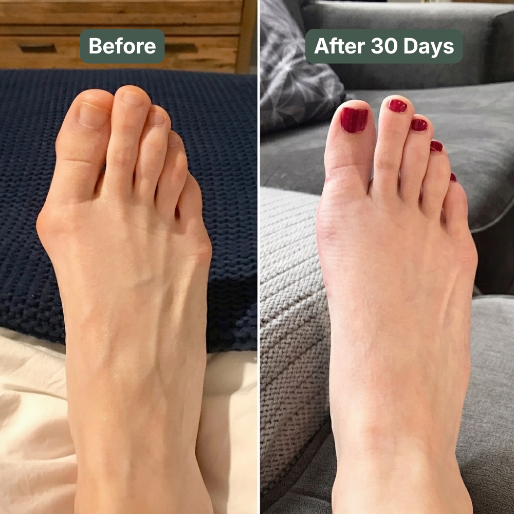 Straighten Your Bunion At Home - Visible Relief in as Little as 30 Days